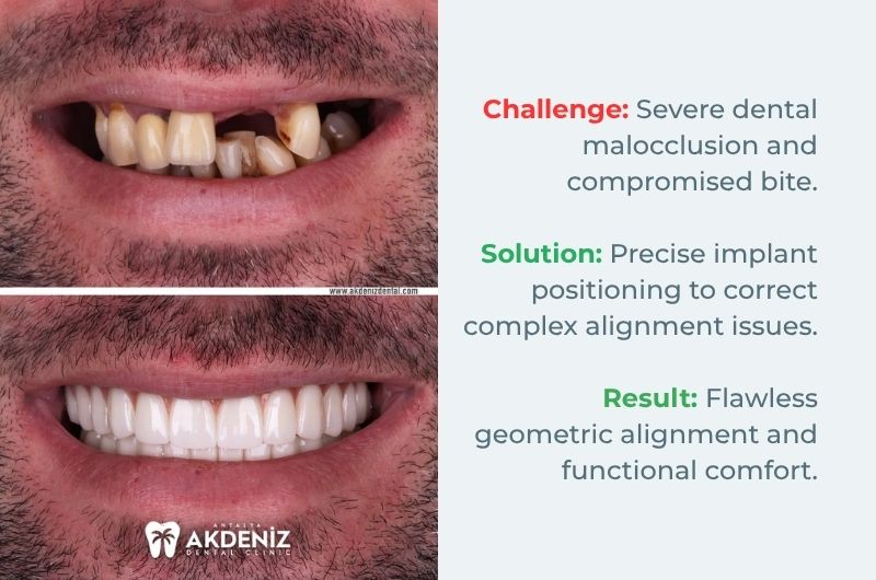 All on 4 dental implants before and after Turkey Antalya